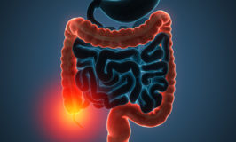 Why are 3 in 10 adults never screened for Colon Cancer?